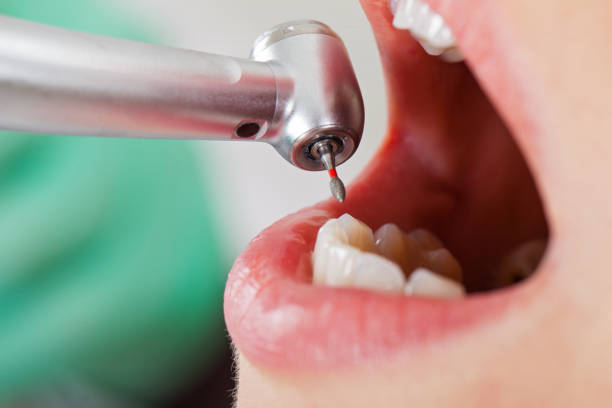 Best Emergency Dentist for Knocked-Out Tooth in Woodsfield, OH
